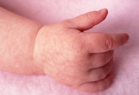 Все о атопическом дерматите у детей