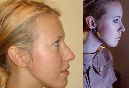 Ксения Собчак сделала пластическую операцию